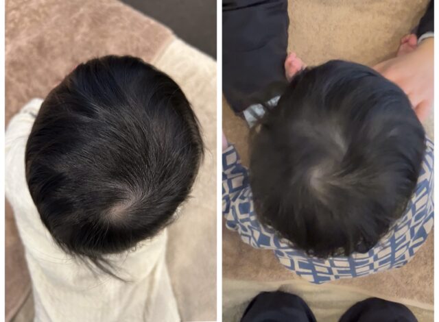 8カ月半男児 施術8回終了時