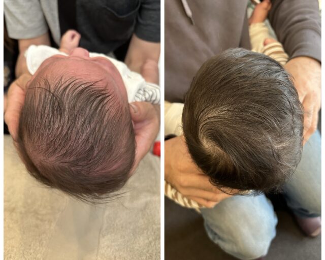 7ヶ月男児 施術10回とヘルメット治療を始めて2週間